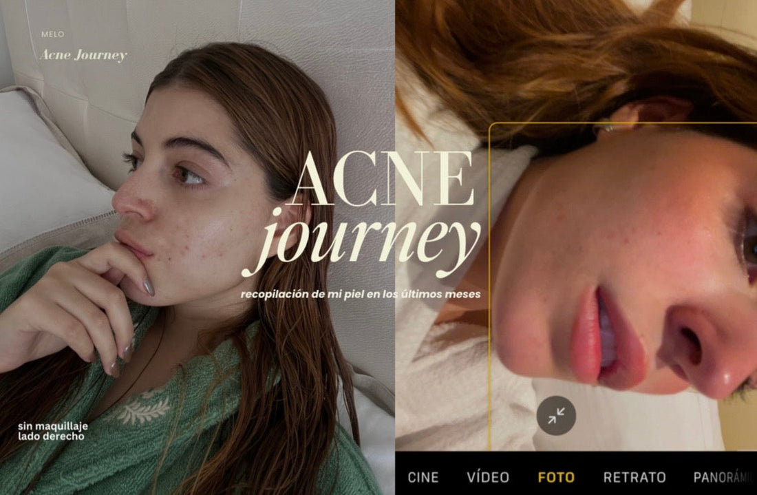 Acné journey <3